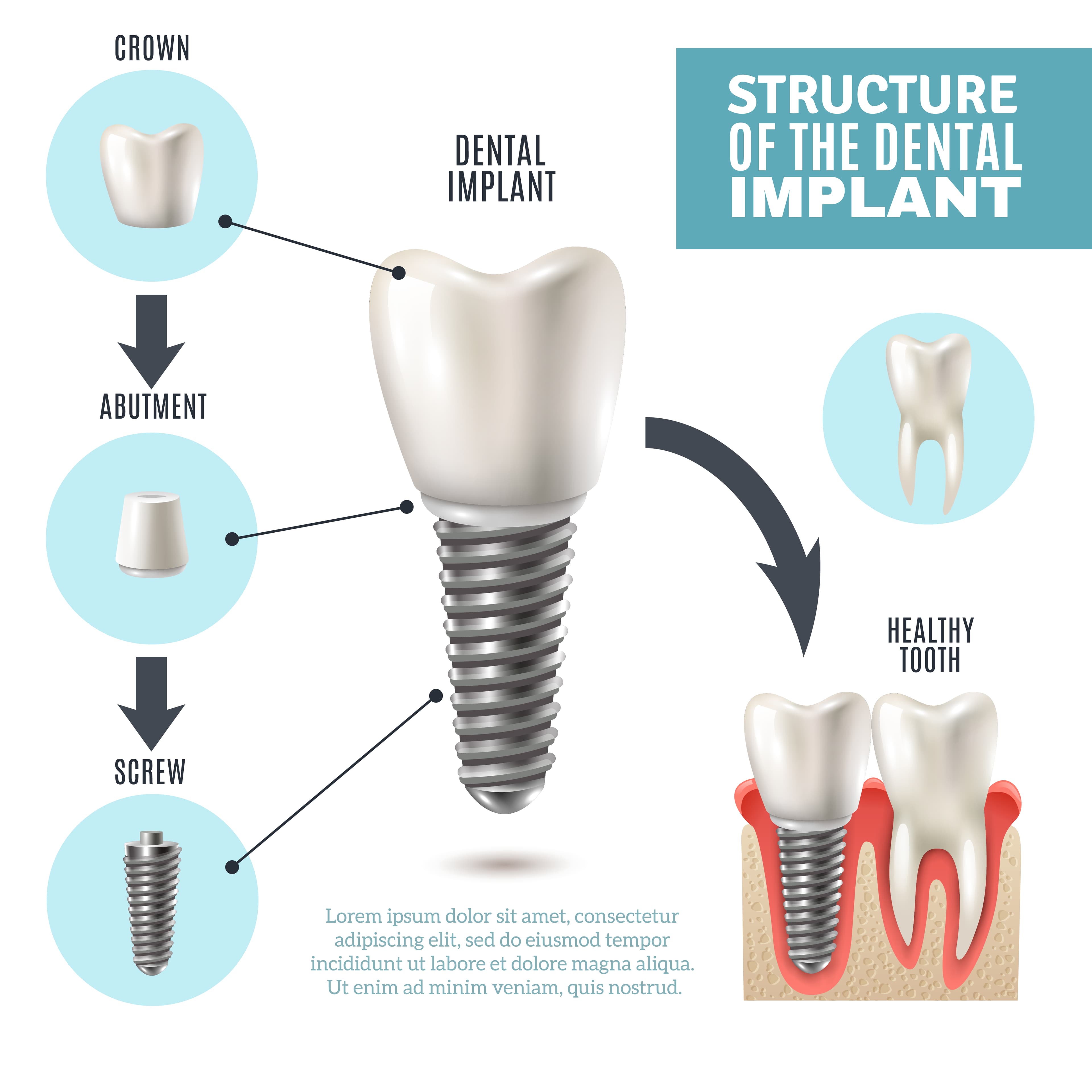 Implant Structure